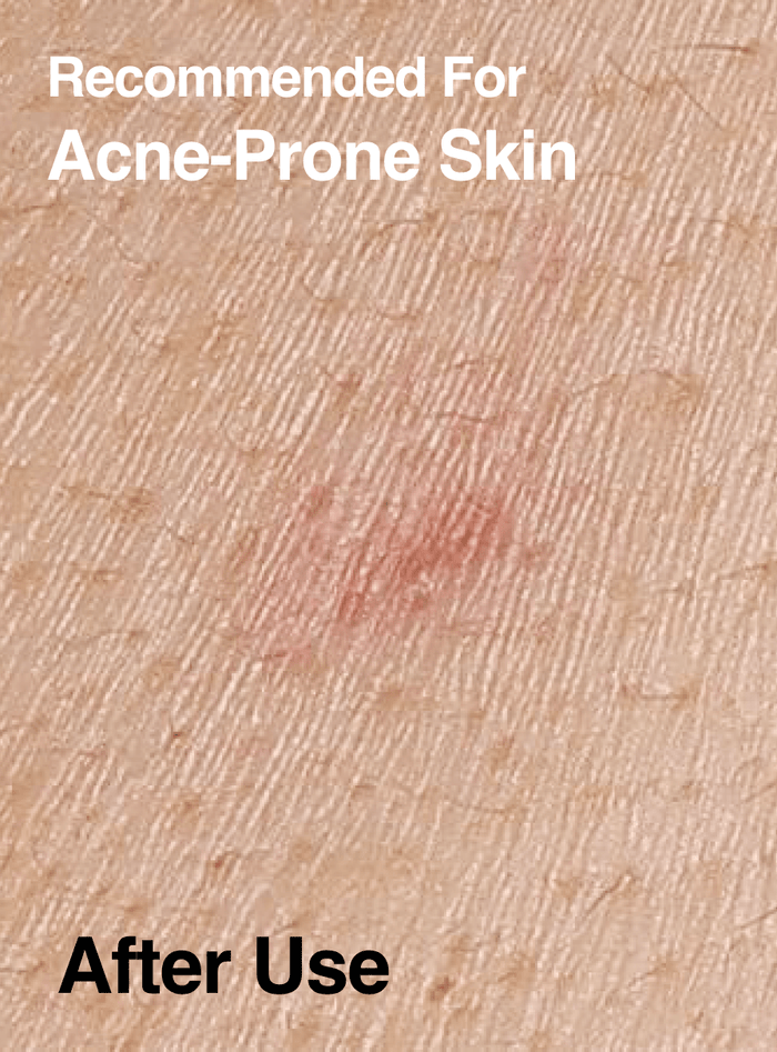 Azelaic 10 Hyaluron Redness Soothing Pad | Anua US