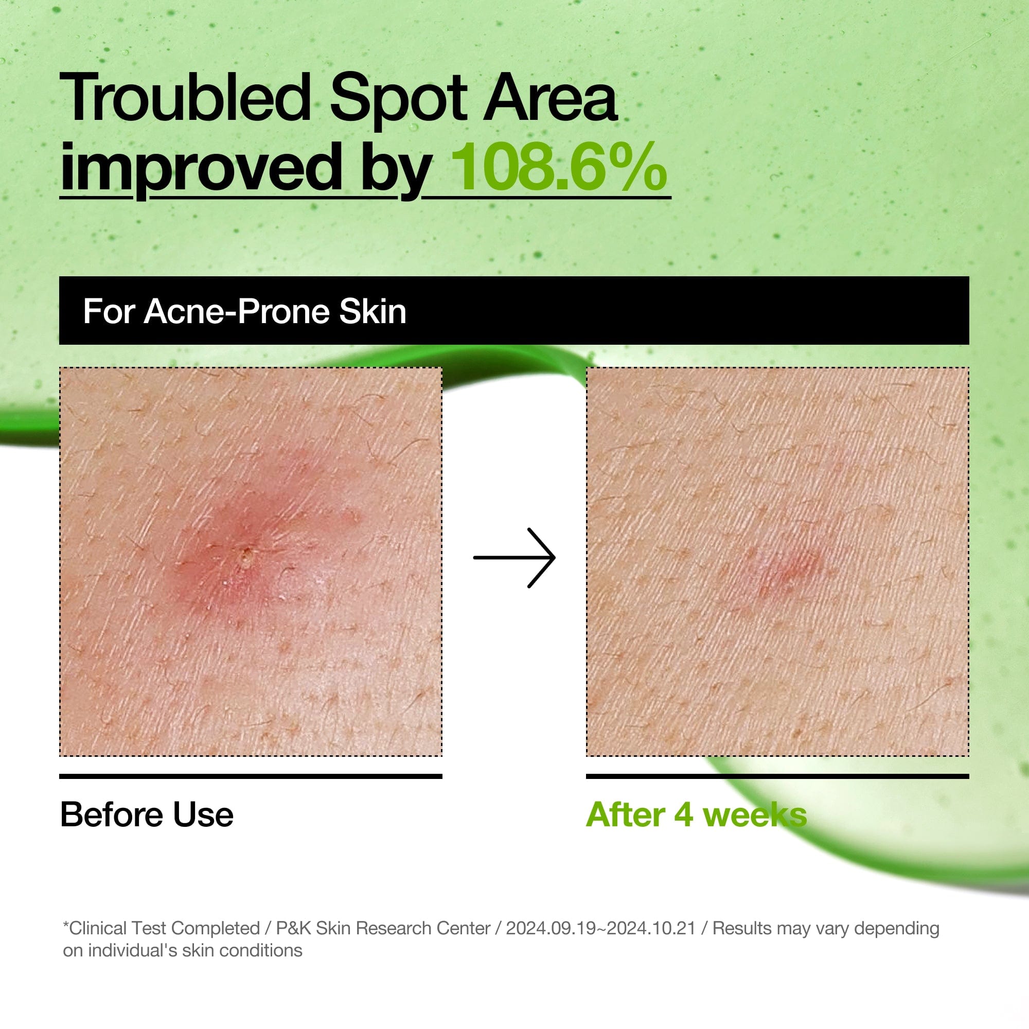 Anua US Ampoule/Serum Azelaic Acid 10 Hyaluron Redness Soothing Serum