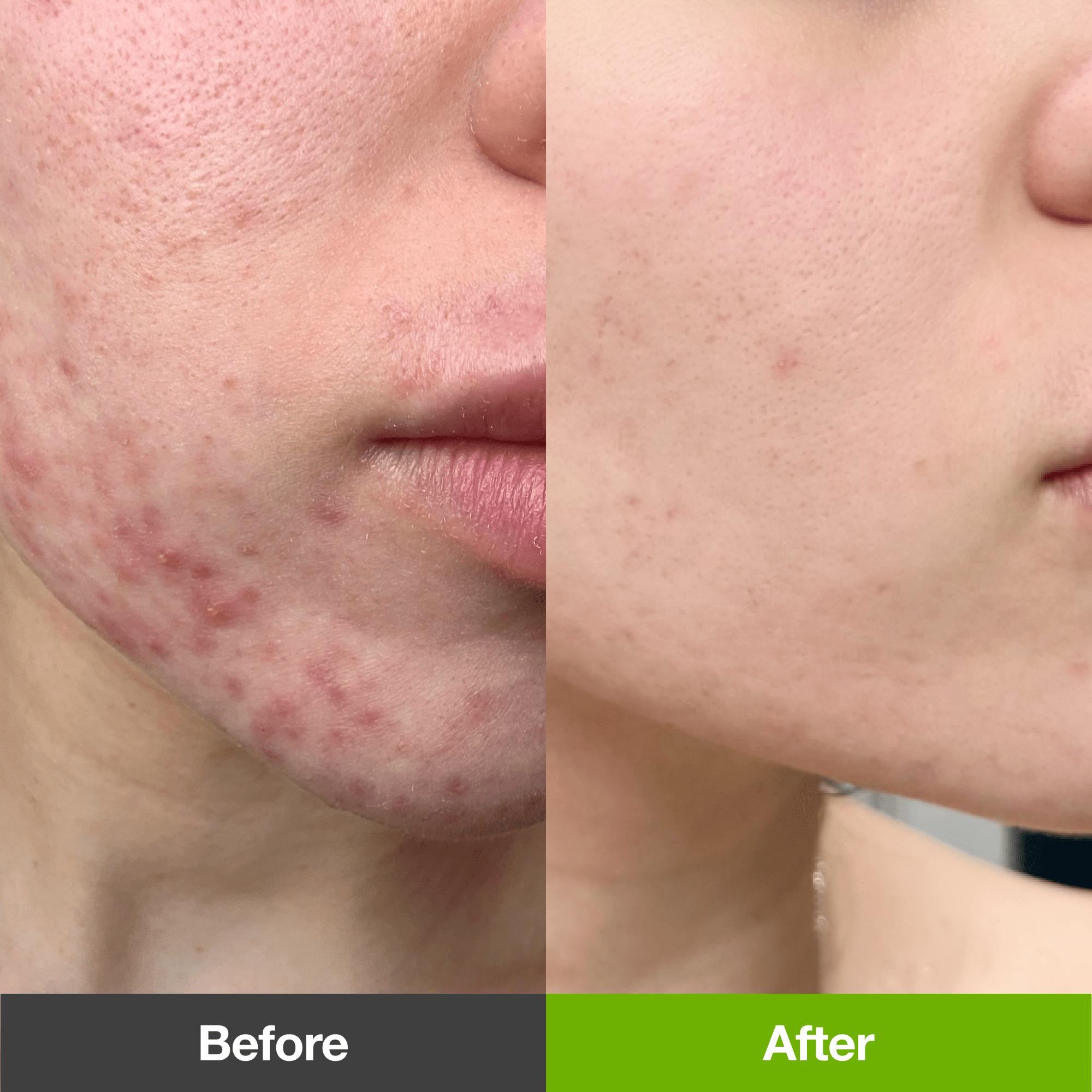 Anua US Bundle Breakout Care Routine Set [44%] Breakout Care Routine Set