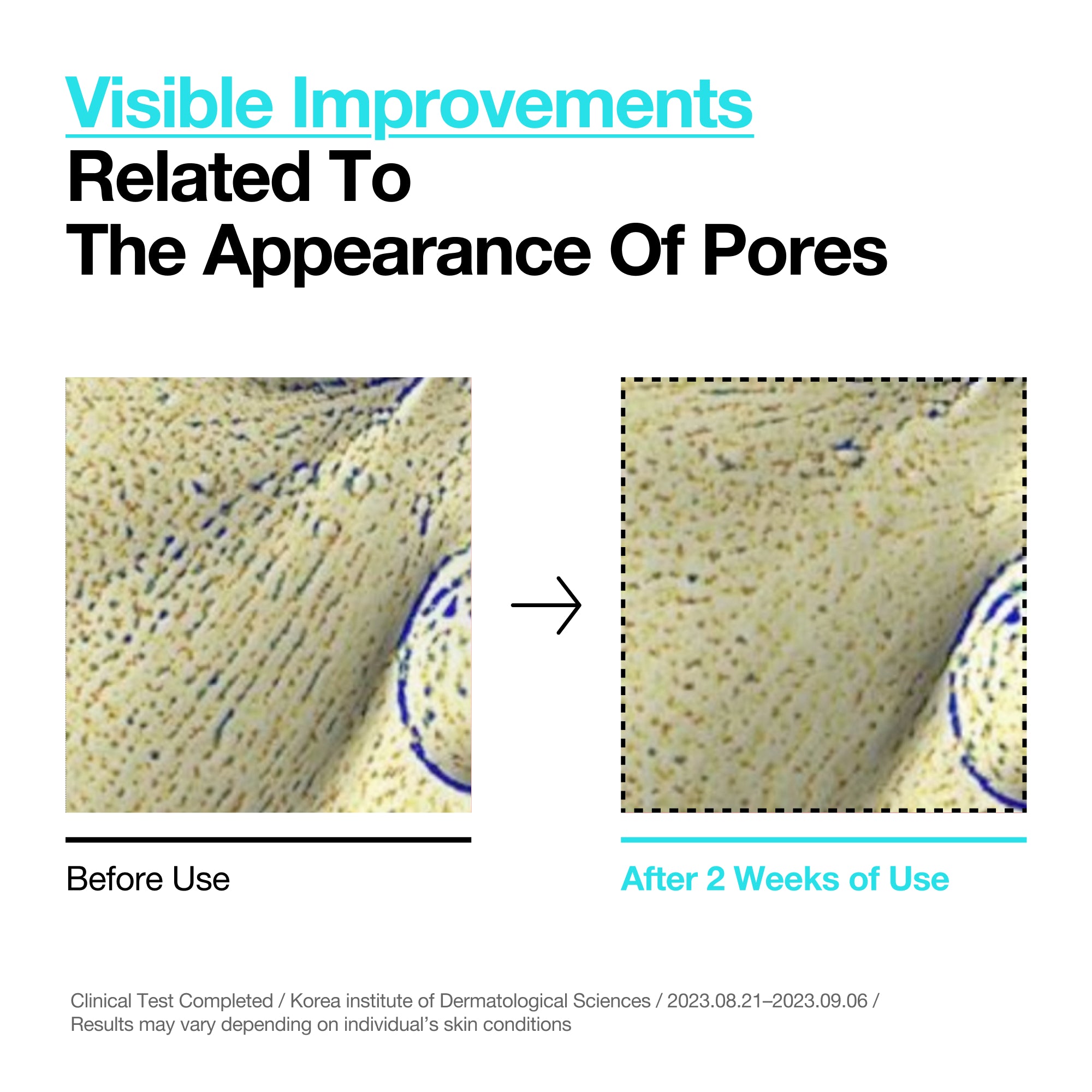 Anua US Toner 150ml BHA 2% Gentle Exfoliating Toner