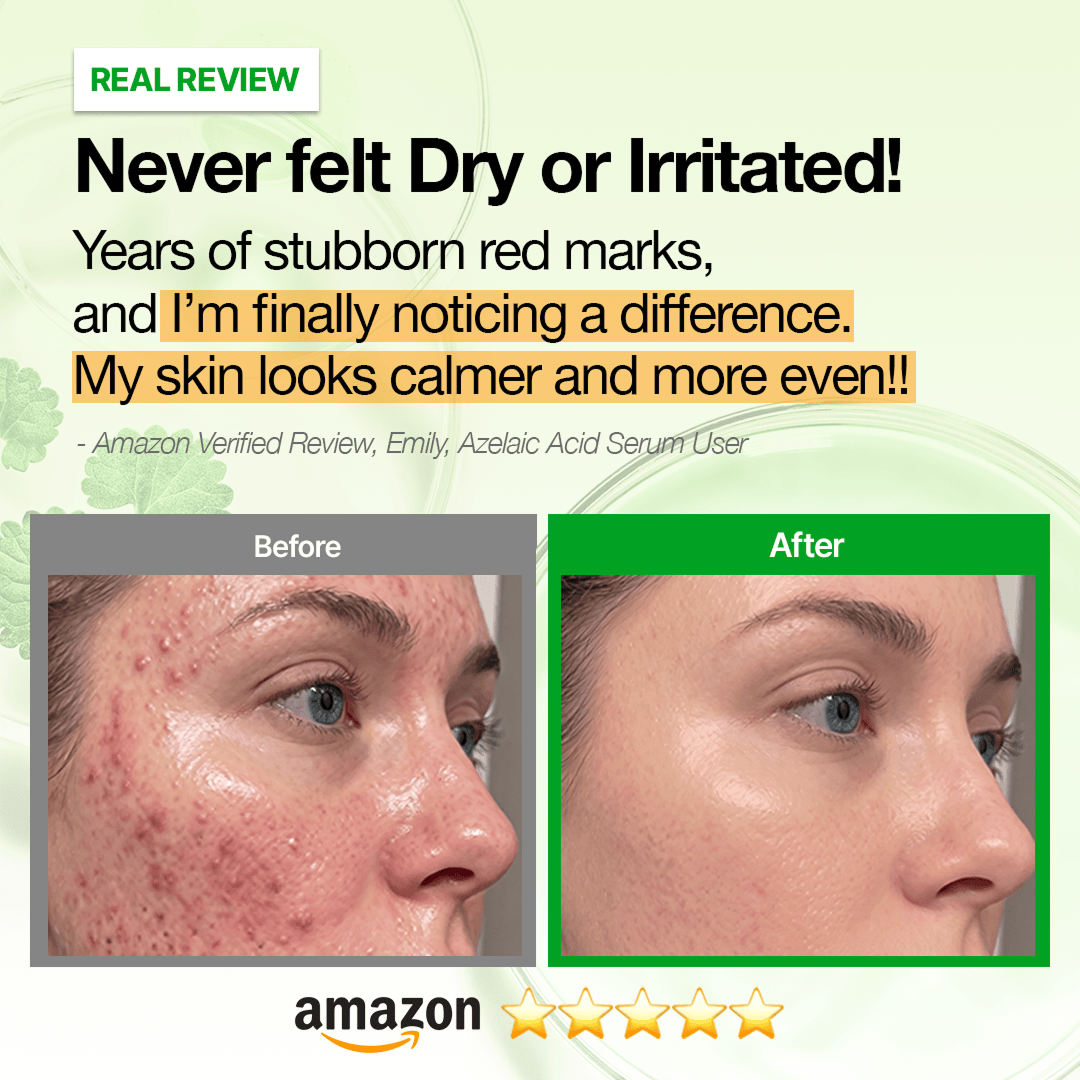 Hidden [Amazon No.1🏆] ANUA Breakout Control Serum