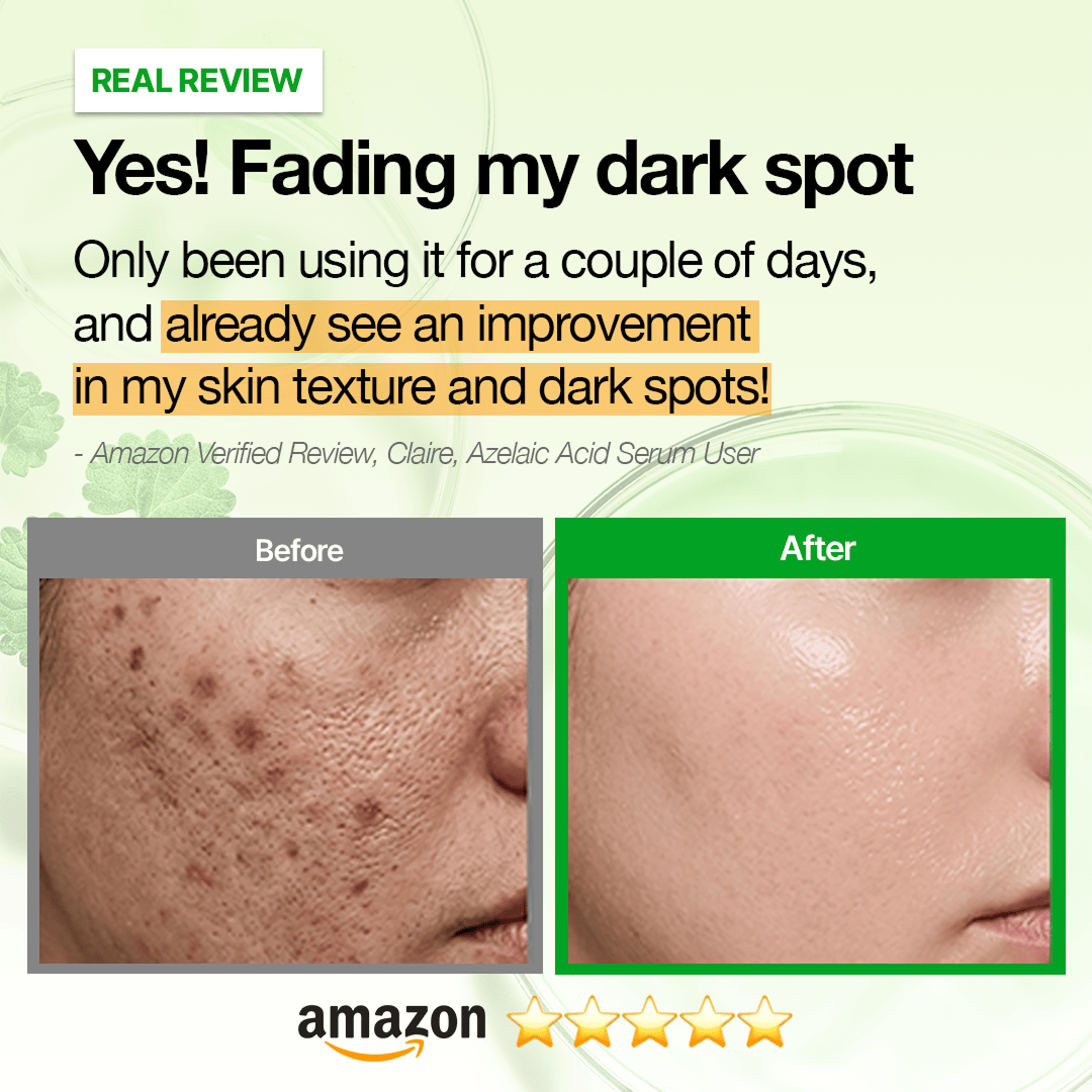 Hidden [Amazon No.1🏆] ANUA Breakout Control Serum