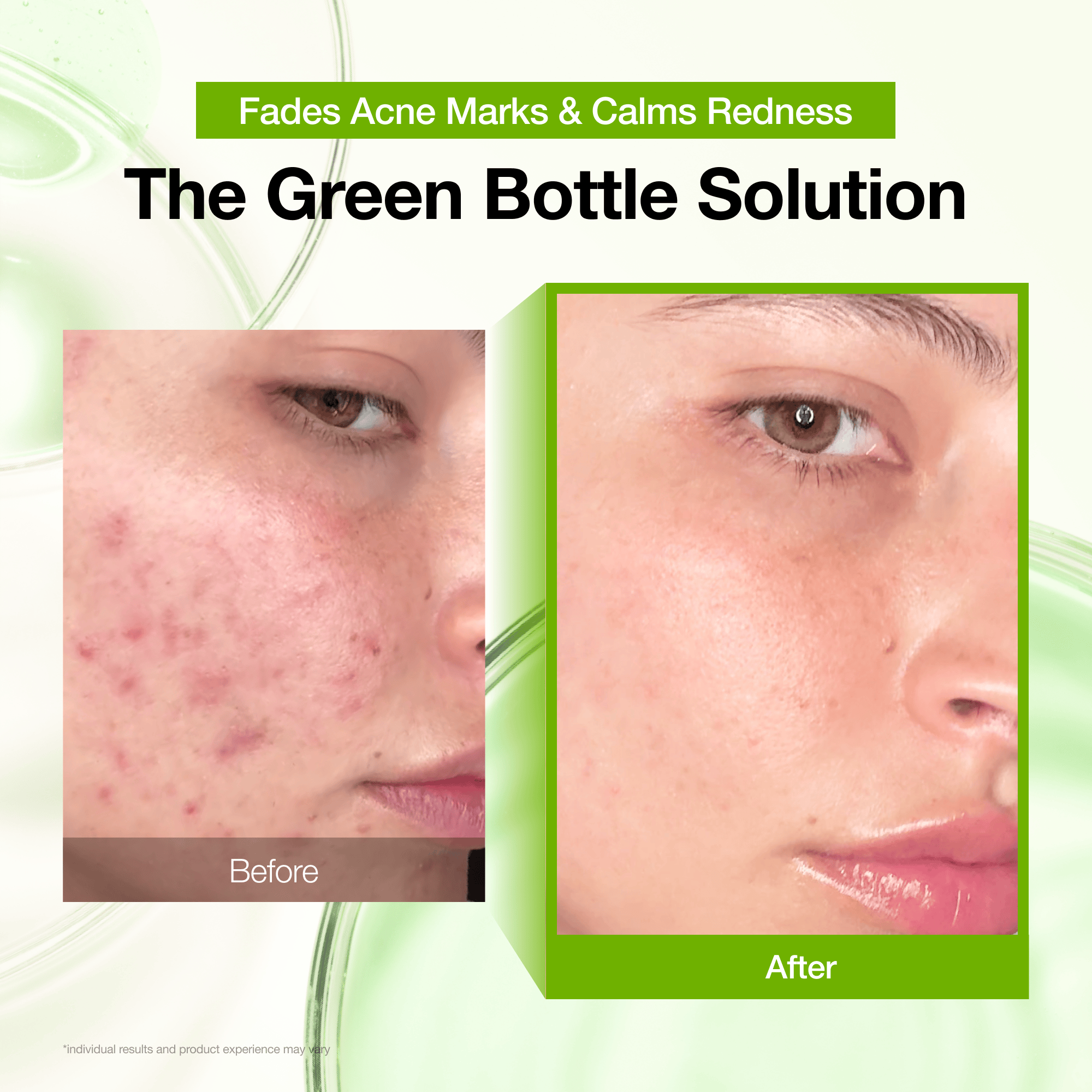 Hidden [Amazon No.1] Azelaic Acid Redness Soothing Serum
