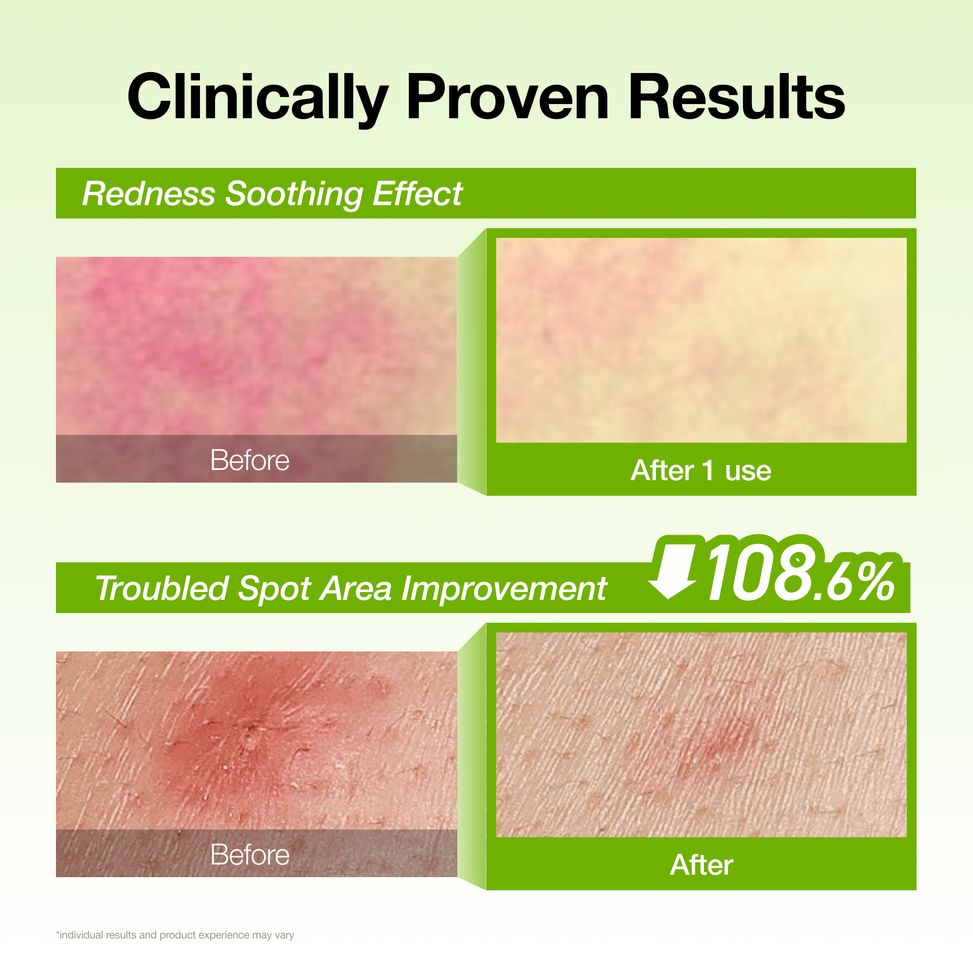Hidden [Amazon No.1] Azelaic Acid Redness Soothing Serum