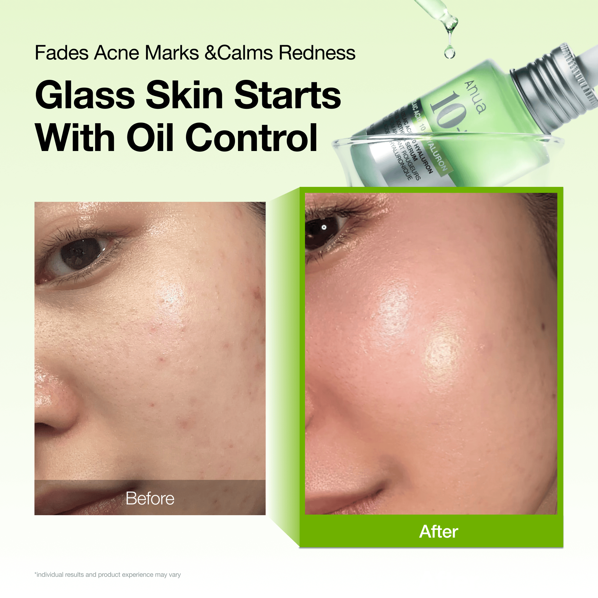 Hidden [Amazon No.1] Azelaic Acid Redness Soothing Serum